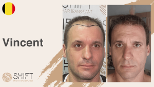 Una miniatura de un testimonio en vídeo sobre trasplante capilar en SHIFT Hair en Turquía realizado por el Sr Vincent