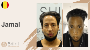 Une vignette d'un témoignage vidéo sur la greffe de cheveux chez SHIFT Hair en Turquie par M Jamal