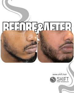 Afro Beard Transplant Turkey Before After SHIFT Hair Transplant in Istanbul 06 3