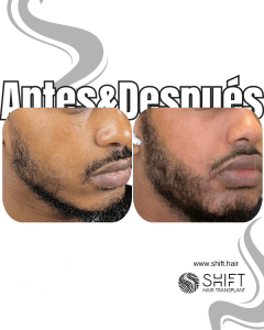 Antes Después de un trasplante de barba afro en Turquía en SHIFT Hair en Estambul 06 3
