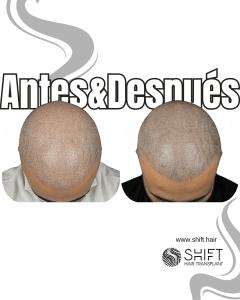 Antes y después de una micropigmentación capilar para un look afeitado en Turquía en SHIFT Hair en Estambul 53 3