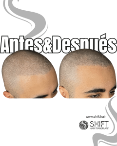 Antes y después de una micropigmentación capilar para un look afeitado en Turquía en SHIFT Hair en Estambul 54 3