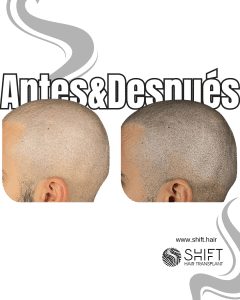 Antes y después de una micropigmentación capilar para un look afeitado en Turquía en SHIFT Hair en Estambul 55 3