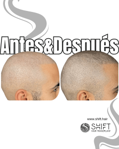Antes y después de una micropigmentación capilar para un look afeitado en Turquía en SHIFT Hair en Estambul 56 3