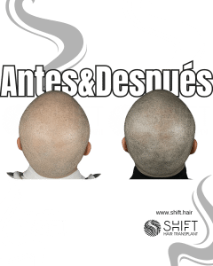 Antes y después de una micropigmentación capilar para un look afeitado en Turquía en SHIFT Hair en Estambul 57 3