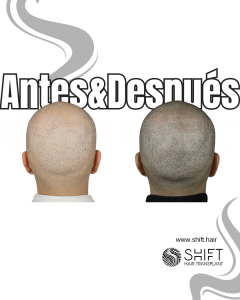 Antes y después de una micropigmentación capilar para un look afeitado en Turquía en SHIFT Hair en Estambul 58 3