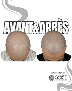 Avant Après de la micropigmentation du cuir chevelu pour un look rasé en Turquie chez SHIFT Hair à Istanbul 53 3