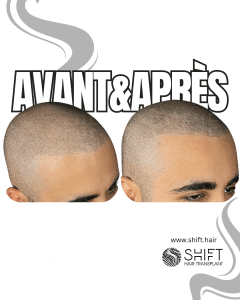 Avant Après de la micropigmentation du cuir chevelu pour un look rasé en Turquie chez SHIFT Hair à Istanbul 54 3
