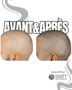 Avant Après de la micropigmentation du cuir chevelu pour un look rasé en Turquie chez SHIFT Hair à Istanbul 55 3