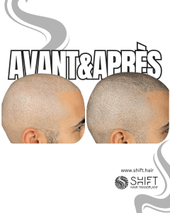 Avant Après de la micropigmentation du cuir chevelu pour un look rasé en Turquie chez SHIFT Hair à Istanbul 56 3