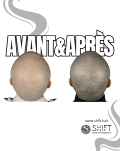 Avant Après de la micropigmentation du cuir chevelu pour un look rasé en Turquie chez SHIFT Hair à Istanbul 57 3