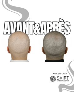 Avant Après de la micropigmentation du cuir chevelu pour un look rasé en Turquie chez SHIFT Hair à Istanbul 58 3