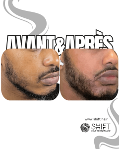 Avant Après une greffe de barbe afro en Turquie chez SHIFT Hair à Istanbul 06 3
