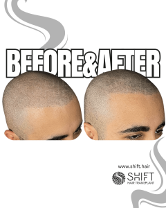 Scalp Micropigmentation for the Shaved Look Turkey Before After SHIFT Hair Transplant in Istanbul 54 3