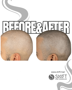 Scalp Micropigmentation for the Shaved Look Turkey Before After SHIFT Hair Transplant in Istanbul 55 3