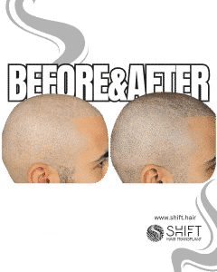 Scalp Micropigmentation for the Shaved Look Turkey Before After SHIFT Hair Transplant in Istanbul 56 3