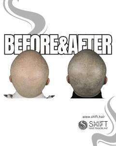 Scalp Micropigmentation for the Shaved Look Turkey Before After SHIFT Hair Transplant in Istanbul 57 3