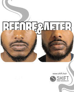 Afro Beard Transplant Turkey Before After SHIFT Hair Transplant in Istanbul 07 3