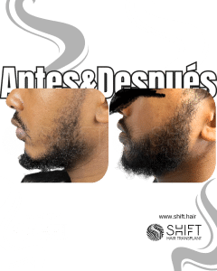 Antes Después de un trasplante de barba afro en Turquía en SHIFT Hair en Estambul 08 3