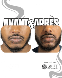 Avant Après une greffe de barbe afro en Turquie chez SHIFT Hair à Istanbul 07 3