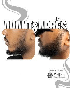Avant Après une greffe de barbe afro en Turquie chez SHIFT Hair à Istanbul 08 3