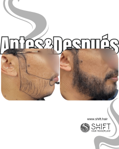 Antes Después de un trasplante de barba en Turquía en SHIFT Hair en Estambul 23 3