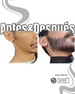 Antes Después de un trasplante de barba en Turquía en SHIFT Hair en Estambul 24 3