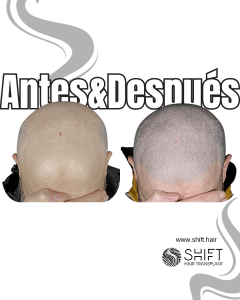 Antes y después de una micropigmentación capilar para un look afeitado en Turquía en SHIFT Hair en Estambul 60 3