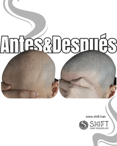 Antes y después de una micropigmentación capilar para un look afeitado en Turquía en SHIFT Hair en Estambul 61 3