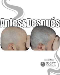 Antes y después de una micropigmentación capilar para un look afeitado en Turquía en SHIFT Hair en Estambul 63 3