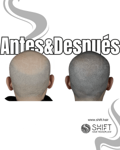 Antes y después de una micropigmentación capilar para un look afeitado en Turquía en SHIFT Hair en Estambul 66 3