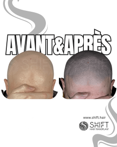 Avant Après de la micropigmentation du cuir chevelu pour un look rasé en Turquie chez SHIFT Hair à Istanbul 59 3