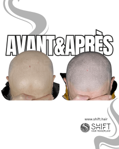 Avant Après de la micropigmentation du cuir chevelu pour un look rasé en Turquie chez SHIFT Hair à Istanbul 60 3