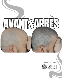 Avant Après de la micropigmentation du cuir chevelu pour un look rasé en Turquie chez SHIFT Hair à Istanbul 62 3