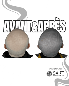 Avant Après de la micropigmentation du cuir chevelu pour un look rasé en Turquie chez SHIFT Hair à Istanbul 64 3