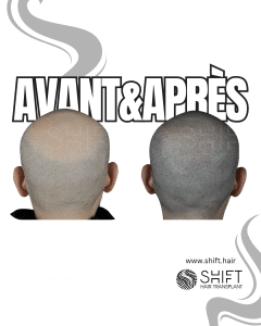Avant Après de la micropigmentation du cuir chevelu pour un look rasé en Turquie chez SHIFT Hair à Istanbul 65 3