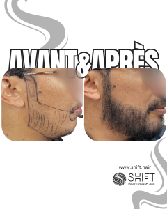 Avant Après une greffe de barbe en Turquie chez SHIFT Hair à Istanbul 21 3