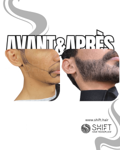 Avant Après une greffe de barbe en Turquie chez SHIFT Hair à Istanbul 24 3
