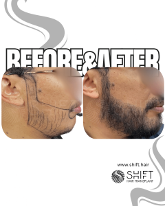 Beard Transplant Turkey Before After SHIFT Hair Transplant in Istanbul 23 3