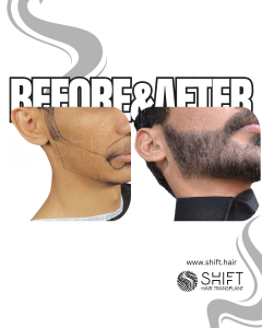 Beard Transplant Turkey Before After SHIFT Hair Transplant in Istanbul 24 3