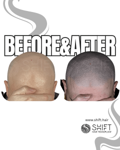Scalp Micropigmentation for the Shaved Look Turkey Before After SHIFT Hair Transplant in Istanbul 59 3