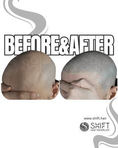 Scalp Micropigmentation for the Shaved Look Turkey Before After SHIFT Hair Transplant in Istanbul 61 3