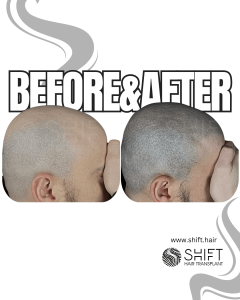 Scalp Micropigmentation for the Shaved Look Turkey Before After SHIFT Hair Transplant in Istanbul 62 3