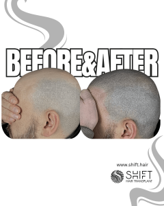 Scalp Micropigmentation for the Shaved Look Turkey Before After SHIFT Hair Transplant in Istanbul 63 3