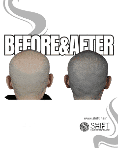 Scalp Micropigmentation for the Shaved Look Turkey Before After SHIFT Hair Transplant in Istanbul 65 3