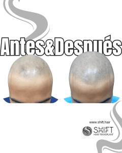 Antes y después de una micropigmentación capilar para un look afeitado en Turquía en SHIFT Hair en Estambul 67 3