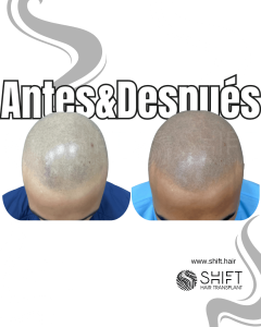 Antes y después de una micropigmentación capilar para un look afeitado en Turquía en SHIFT Hair en Estambul 68 3