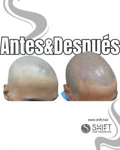 Antes y después de una micropigmentación capilar para un look afeitado en Turquía en SHIFT Hair en Estambul 69 3