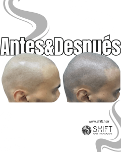 Antes y después de una micropigmentación capilar para un look afeitado en Turquía en SHIFT Hair en Estambul 71 3