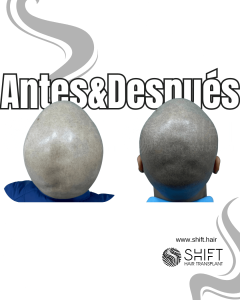 Antes y después de una micropigmentación capilar para un look afeitado en Turquía en SHIFT Hair en Estambul 73 3